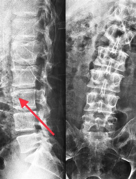 limbus vertebra with back pain.